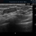 Ultraschall_18