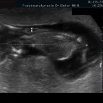 Ultraschall_22