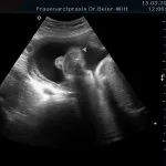 Ultraschall_25