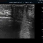 Ultraschall_4
